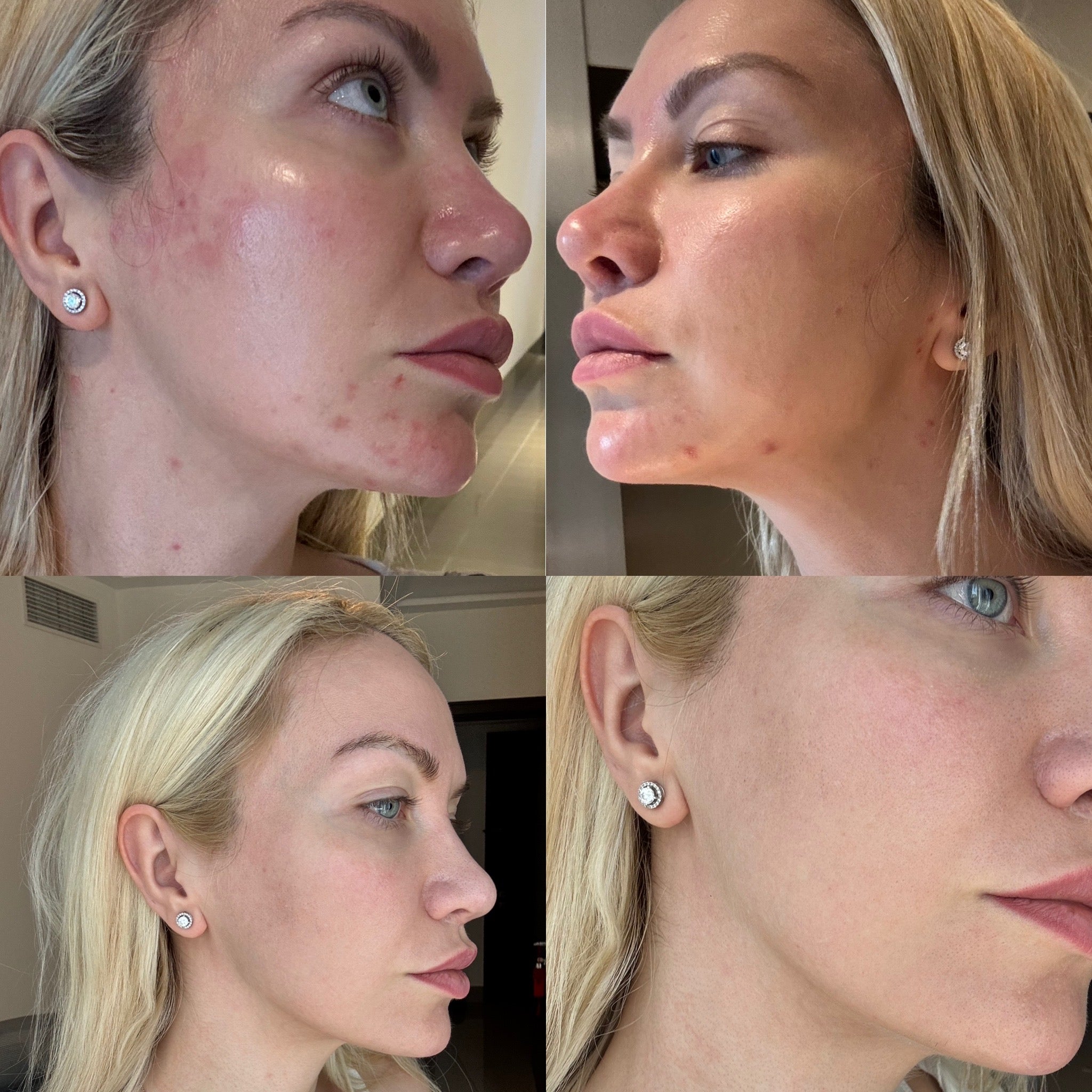 Louise's skin transformation photos